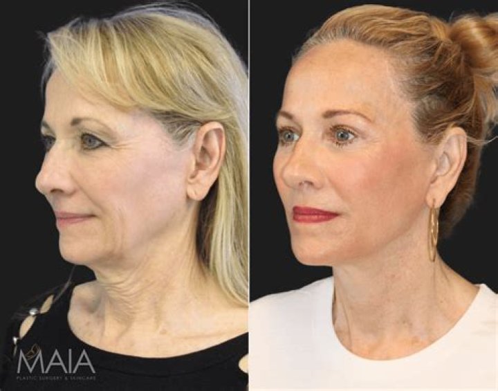 Helen Hunt's Facelift Transformation: A Guide To Her Rejuvenated Look