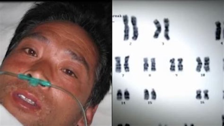 Hisashi Ouchi: The Unfortunate Victim Of Radiation Exposure And The Longest Survivor Of Critical Radiation Syndrome