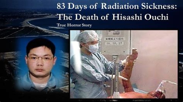 The Tragic Case Of Hisashi Ouchi: Radiation Burns And The Worst Industrial Accident