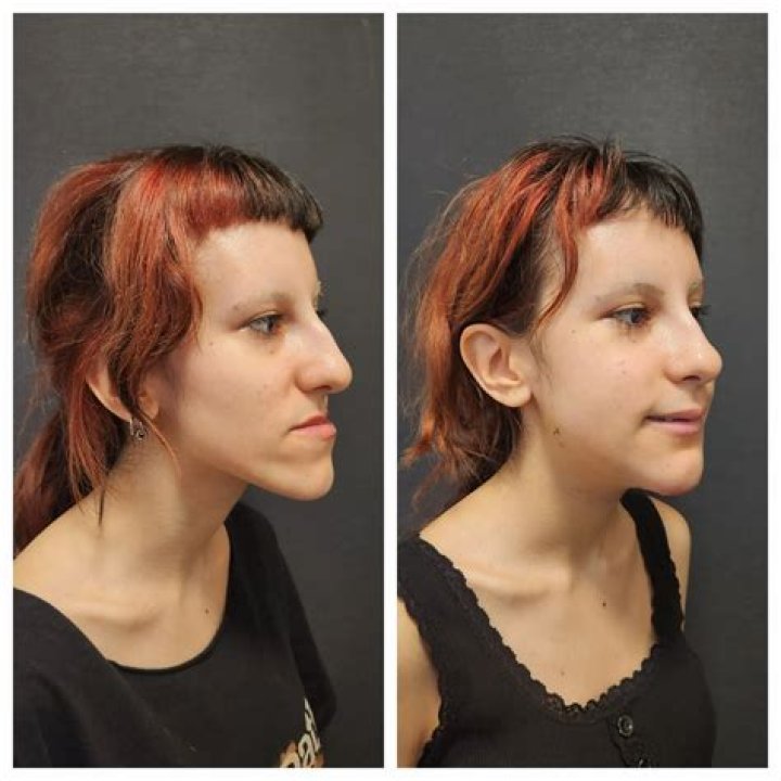 The Ugly Truth: Double Jaw Surgery Gone Horribly Wrong